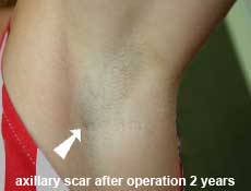 plastic-surgery-breast-augmentation 